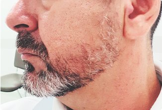 Beard Hair Transplant