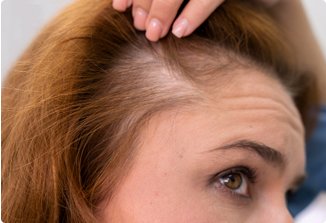 Female Hair Transplant
