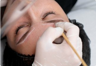 Eyebrow Hair Transplant